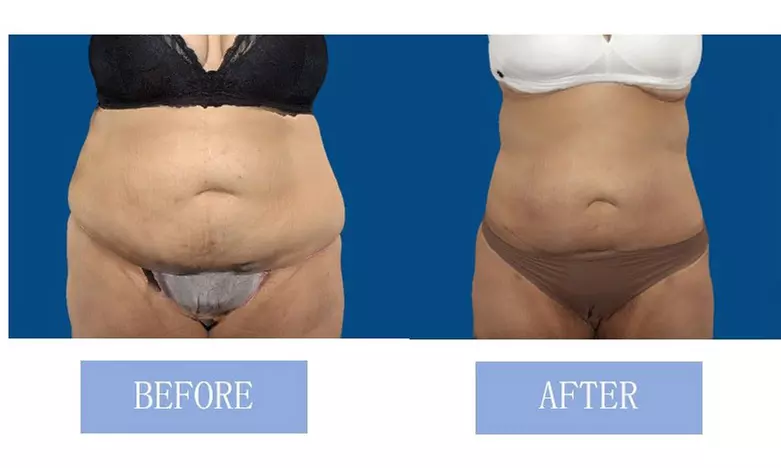 Fat Buster or The Works – Body Consultation, Analysis, or More