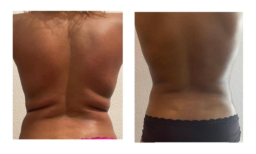 Image 3: 2, 4 o 6 sesiones de maderoterapia corporal con drenaje linfático