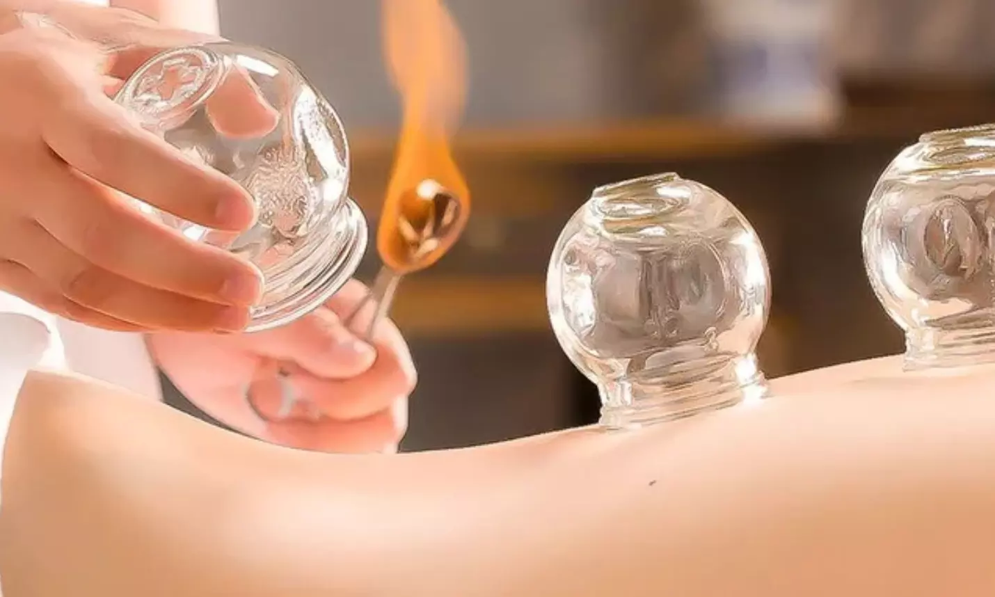 Release and Restore: One 30-Minute Fire Cupping Session with Acupuncture at Family AcuCare ( Up to 70% Off ) - Primary Image