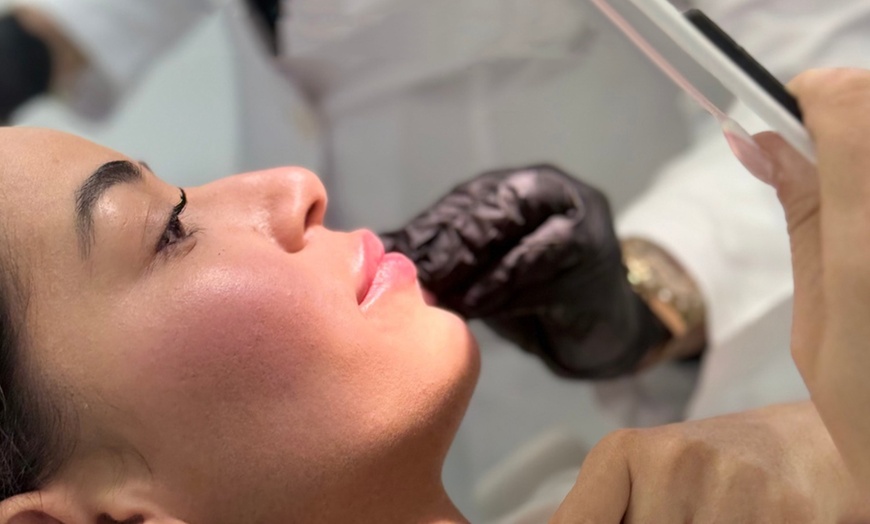 Image 1: Vial infiltrado de relleno dérmico en zona a elegir