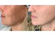 Revitalize with One Lumecca IPL Session for Full Face, Face and Neck or Face, Neck, and Chest ( Up to 47% Off ) - Second Medium