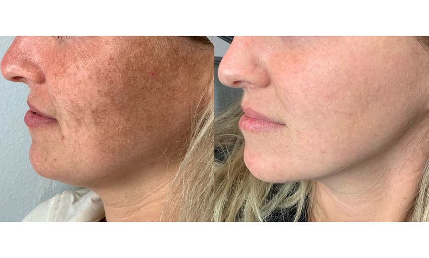 Image 4: Lumecca IPL Session for Full Face, Face and Neck or Face, Neck & Chest