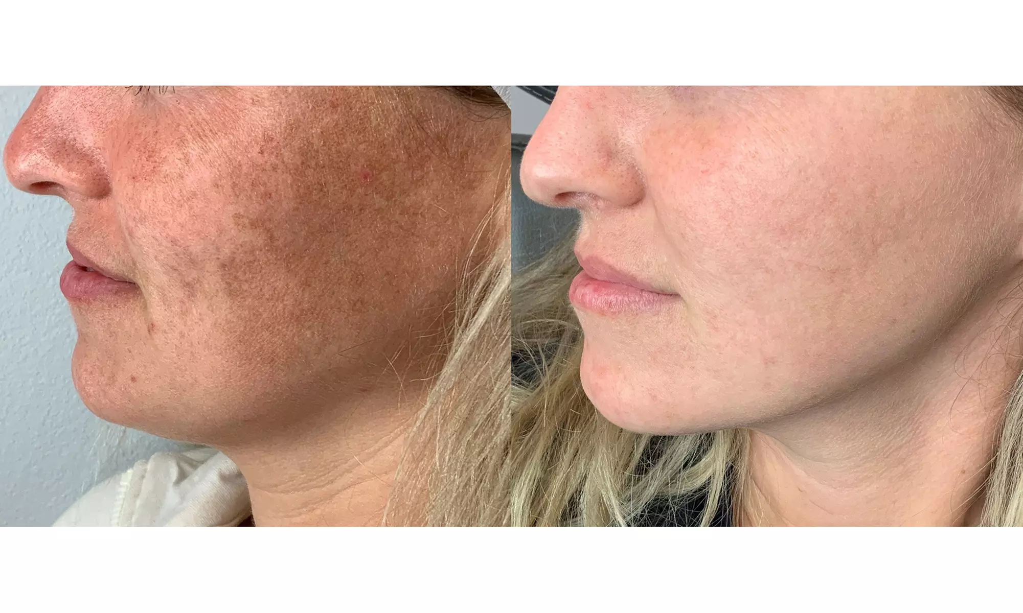 Lumecca IPL Session for Full Face, Face and Neck or Face, Neck & Chest