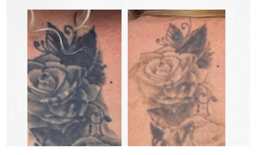 Image 4: Three Laser Tattoo Removal Sessions on an Area (1,3 or 6 Inches)