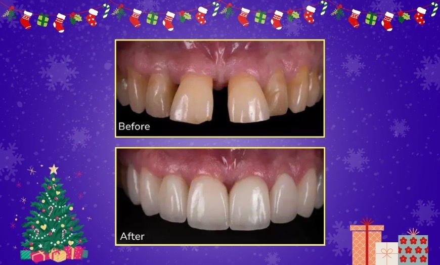 Image 2: Transform Your Smile with StarSmiles Invisible Aligners