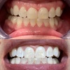 Image 1: Professional Teeth Whitening Treatments