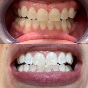 45 Minute In-Office Teeth-Whitening Touchup - Teeth whitening Graceful Gloww by Lizzie