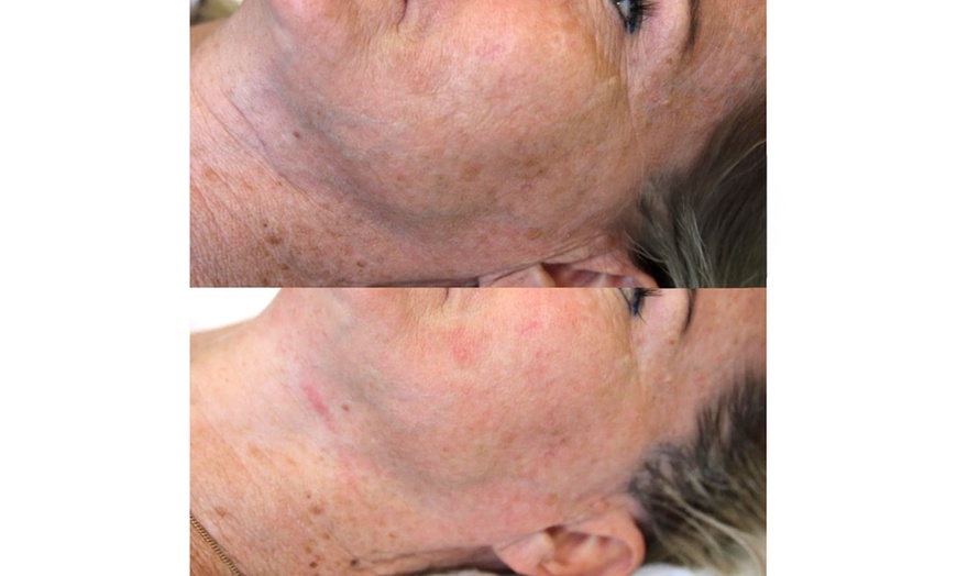 Image 5: Enhance Your Look with HIFU for Neck/Face or Both or Tattoo Eyeliner