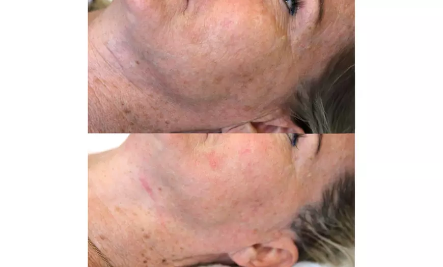 Image 5: Enhance Your Look with HIFU for Neck/Face or Both or Tattoo Eyeliner