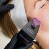 Image 2: Morpheus8 Non-surgical Tightening - Allure Passions Aesthetic Clinic