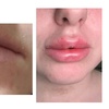 Image 2: Up to 50% Off on Injection - Dermal Filler at Clear skin 33