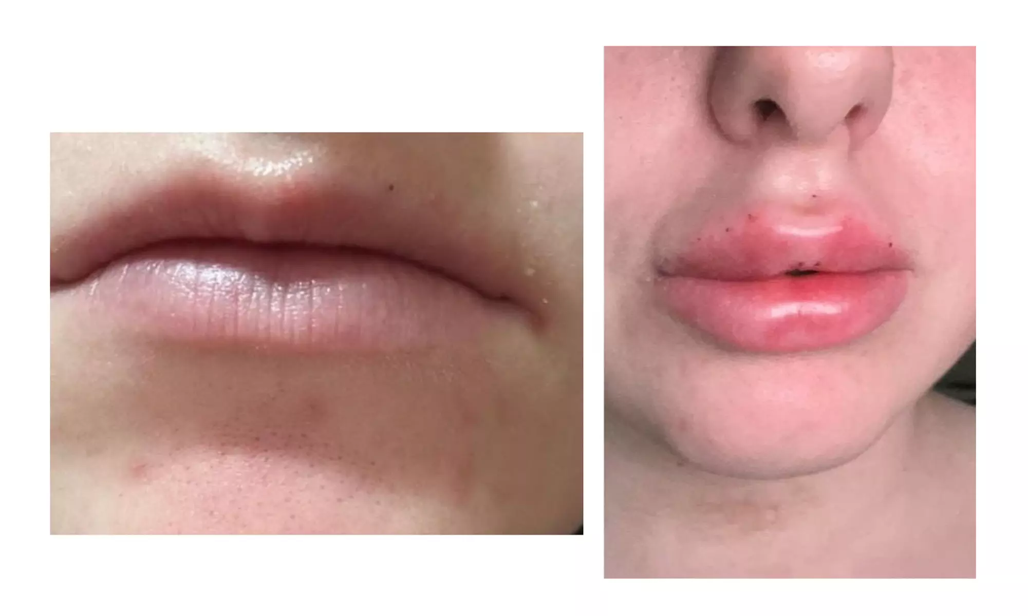 Up to 50% Off on Injection - Dermal Filler at Clear skin 33