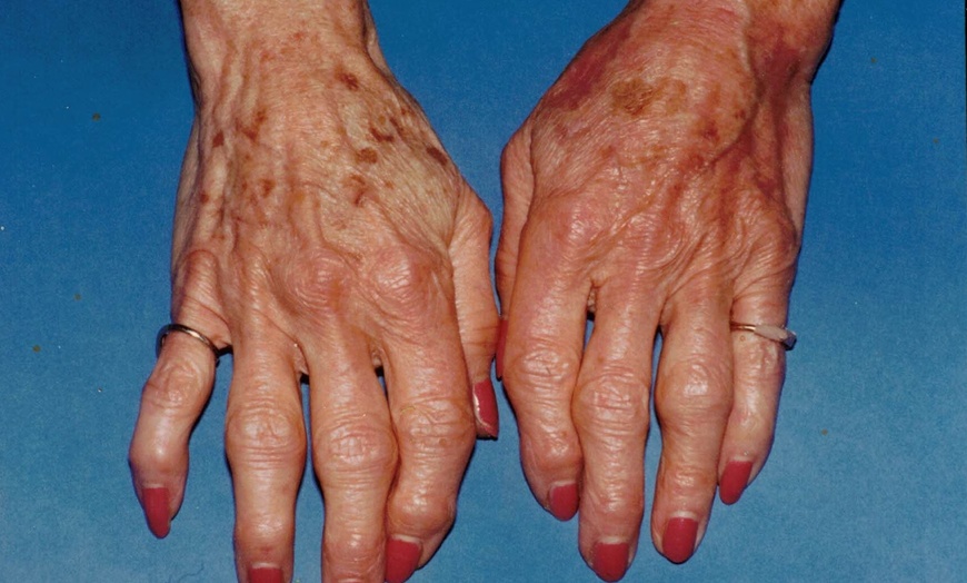 Image 3: Enhance Beauty with Deluxe Hand Rejuvenation! 