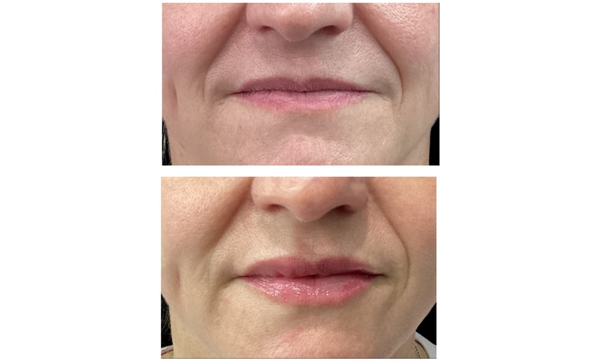 Image 2: Refresh Your Look with 20 or 40 Units of Xeomin