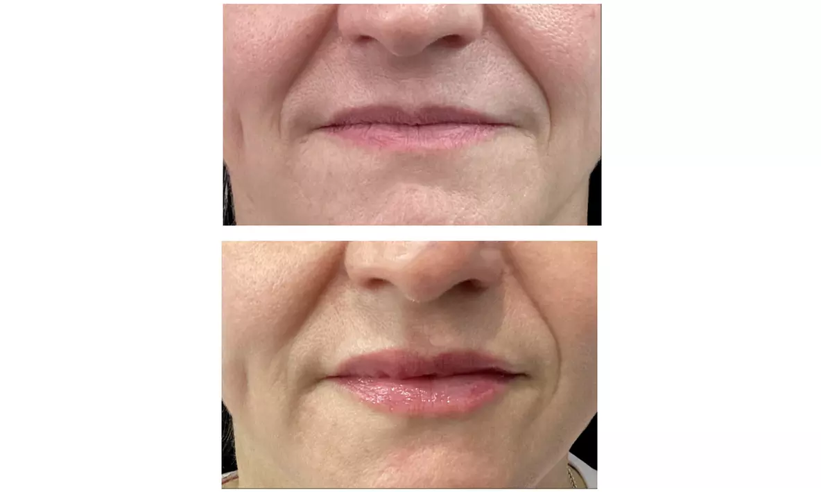 Refresh Your Look with 20 or 40 Units of Xeomin