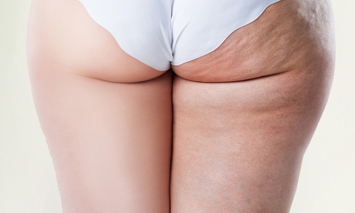 One or Two SPM Suction Pump Massages and Lymphatic Drainage