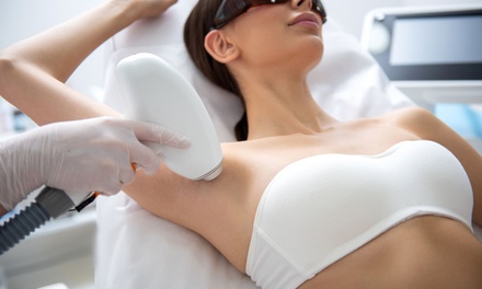 5 séances d'épilation laser : 1 zone du visage (lèvres supérieures ou menton)