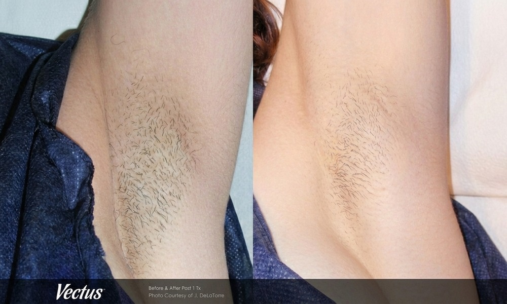 Enjoy Smooth Skin with Five or Six Laser Hair Removal Sessions