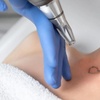 Image 1: Tattoo Removal Sessions