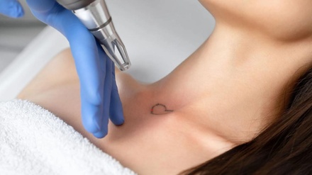 Three Small Tattoo Removal Sessions - Advanced Esthetics LVC