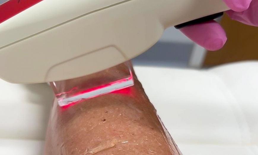 Image 1: Six Laser Hair Removal Sessions on One Small, Medium or Large Area 
