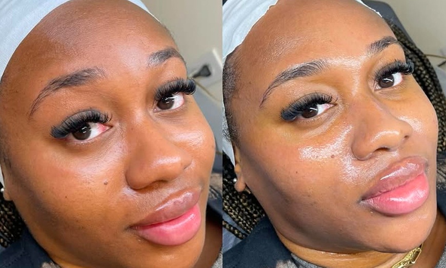 Image 4: Reveal Fresh Skin with One Dermaplane Facial Treatment
