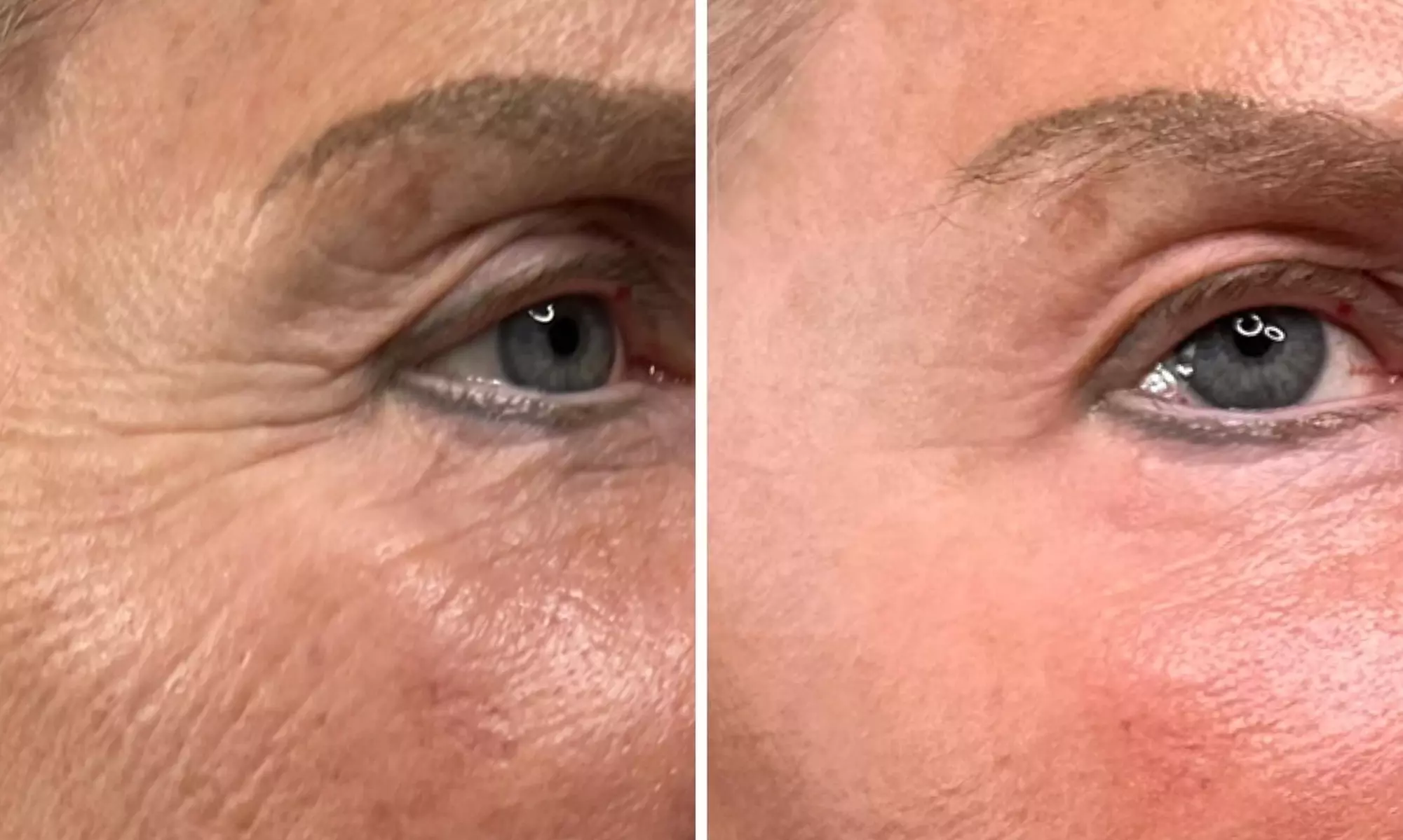 Permanent Makeup & Advanced Microchanneling