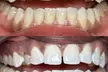 Up to 30% Off on Teeth Whitening at Grin & Glow - Second Medium