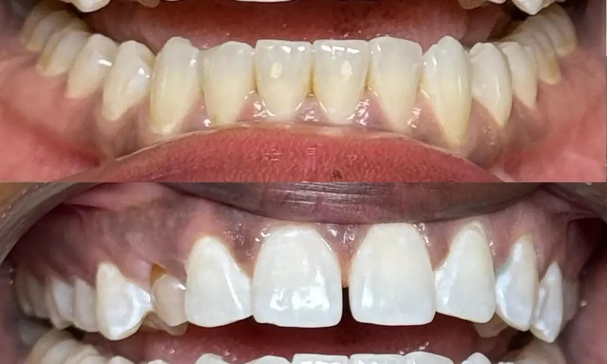 Teeth Whitening Sessions in 30–90 Min or Couples 60–90 Min Options
