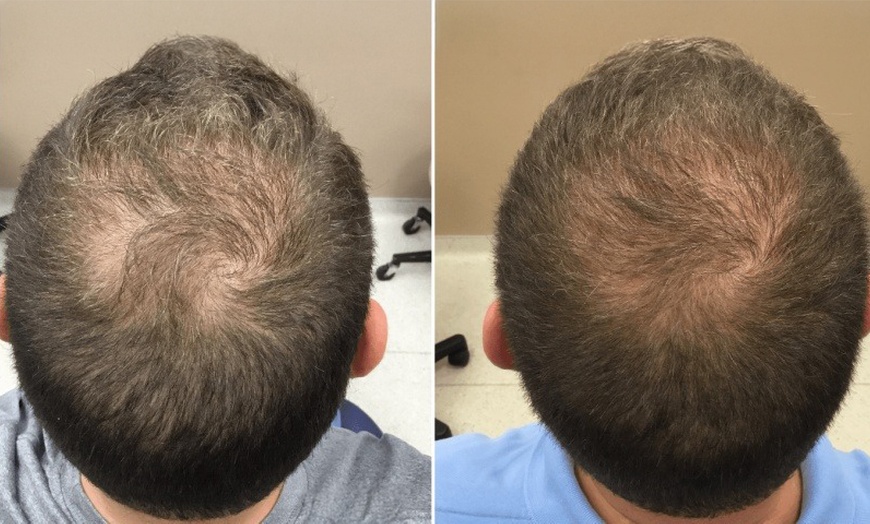 Image 2: Three PRP Tubes for Advanced Hair Restoration Treatment