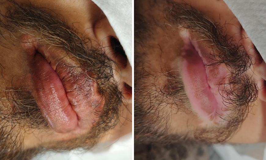 Image 3: Transform Your Skin with Vitiligo or Stretch Marks Camouflage Services