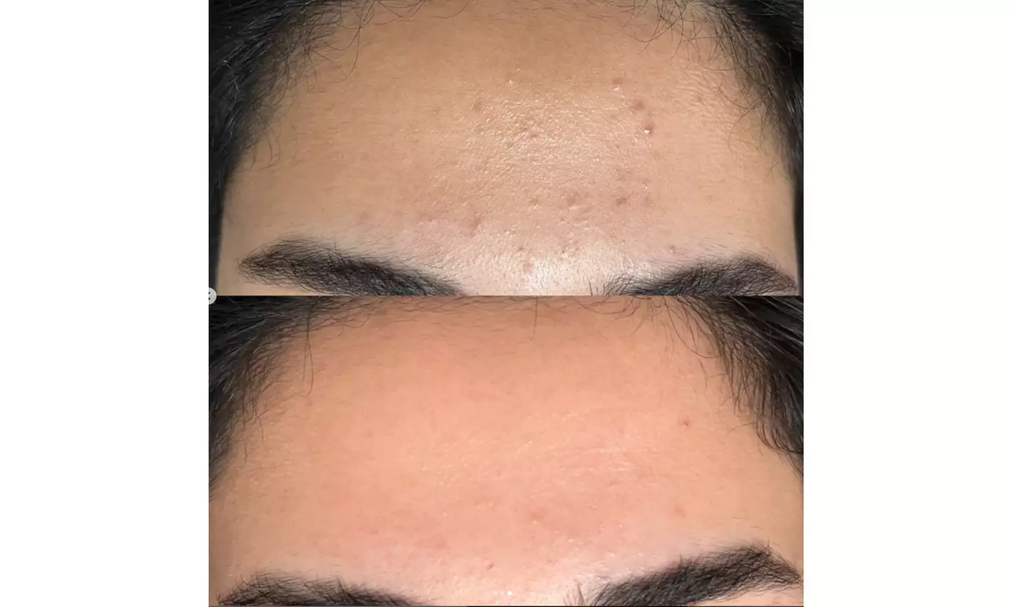 Luxury 1,2 or 3 60-Minute Chemical Peel or Signature Facials