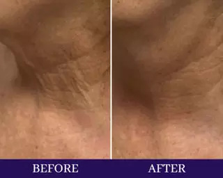 One, Two or Three Sessions of Skin Tightening (35 Minutes Each)