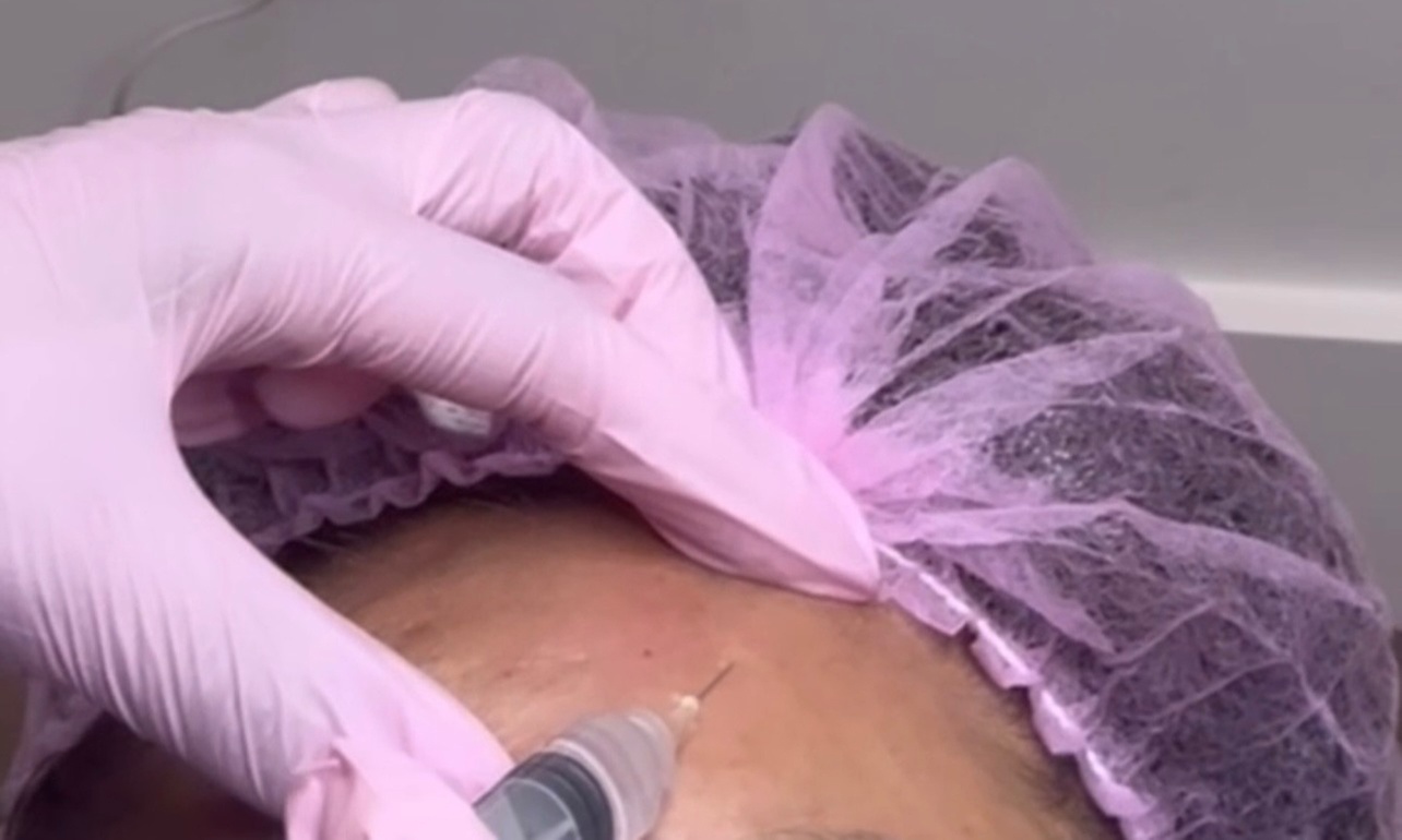 Up to 30% Off on Micro-Needling at Diva Beauty SPA Lashes & Brows