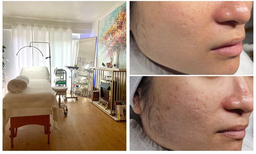 Image 4: One session I-PRF Microneedling at Étoilée Aesthetics