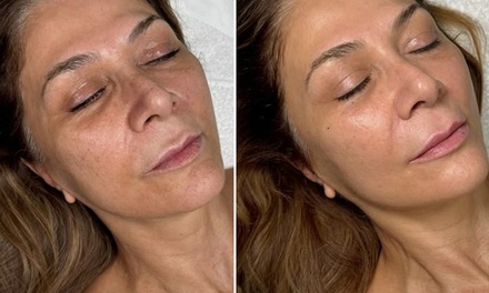 One Session - Full Face ADVATx Laser Facial - Allure Passions Aesthetic Clinic