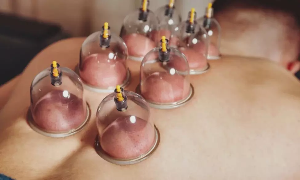 Experience Cupping Treatment with Custom massage 50-or 80-mins