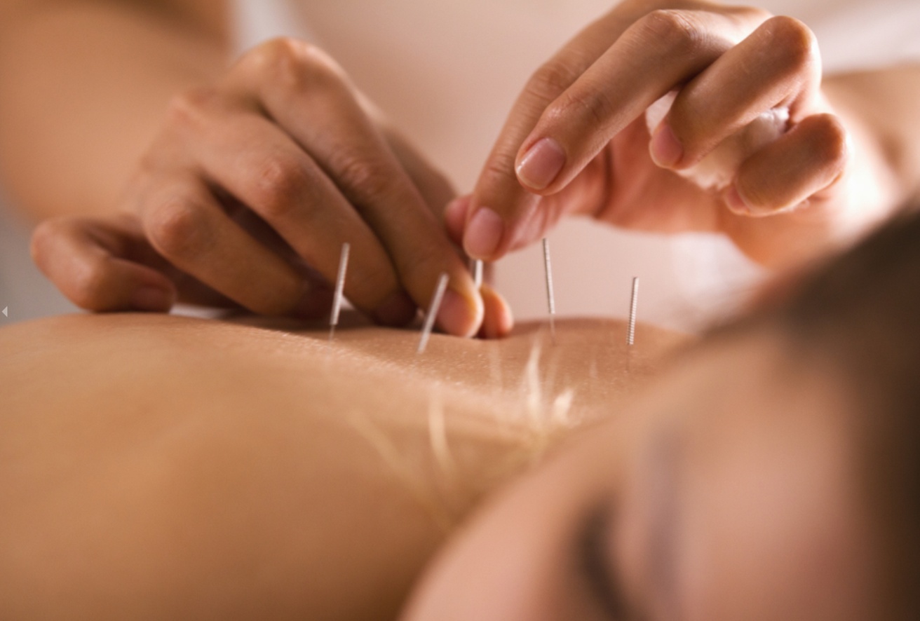 1,2 or 3 30-minute Acupuncture Sessions + Free Consultation