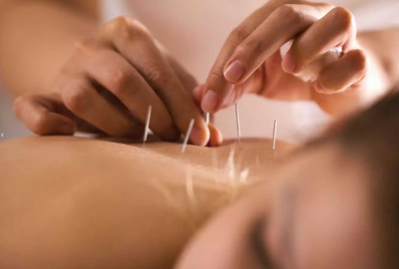 (Up to 62% off) for 3 Revitalizing 60‑Minute Acupuncture Sessions + Free Consultation - Primary Image