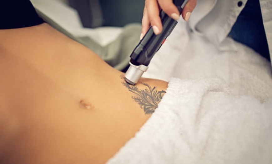 Image 2: Tattoo Removal - Any Area, Skin Camouflage, or Eyebrow Tattoo Removal