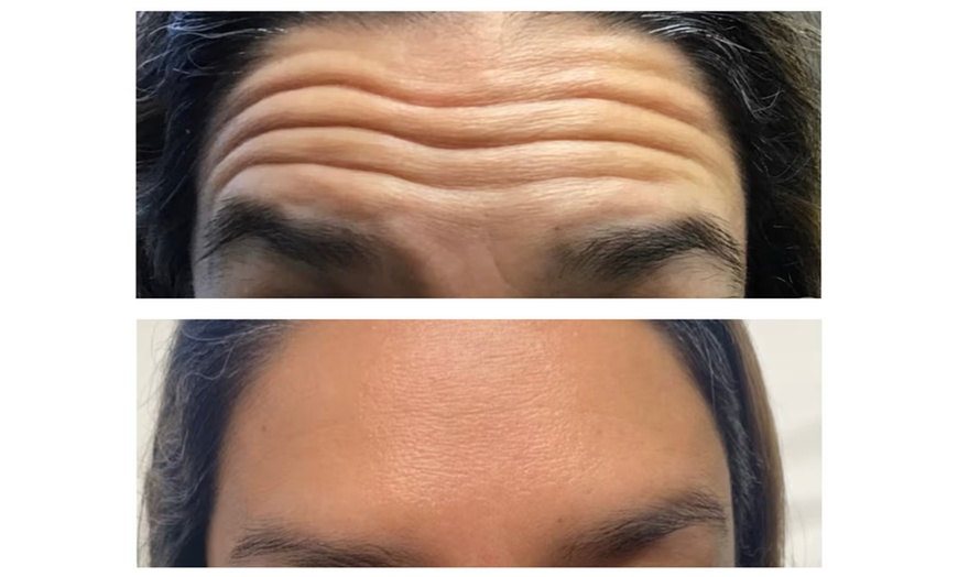 Image 5: Revitalize Your Look with 20 Units of Botox