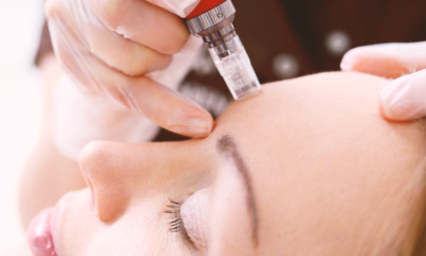 Image 3: 1, 2 o 3 sesiones de microlifting facial de vitaminas con Dermapen