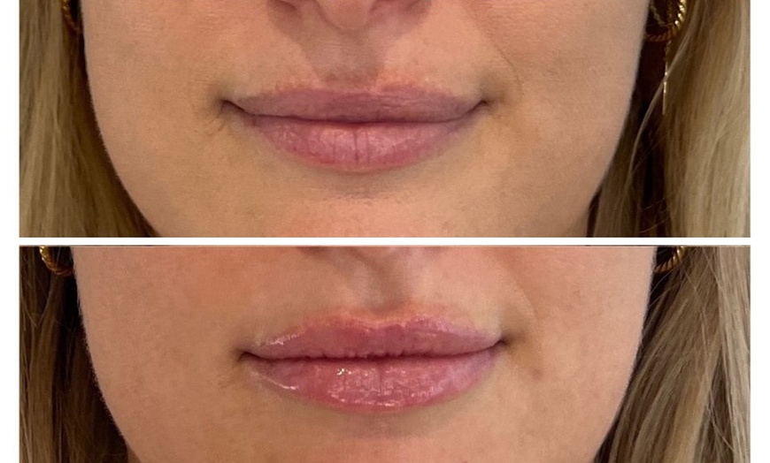 Image 9: 0.5, 1 or 2ml Dermal Filler w/ Consultation: Lip, Smile, Cheek or Chin