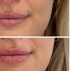 Image 9: 0.5, 1 or 2ml Dermal Filler w/ Consultation: Lip, Smile, Cheek or Chin