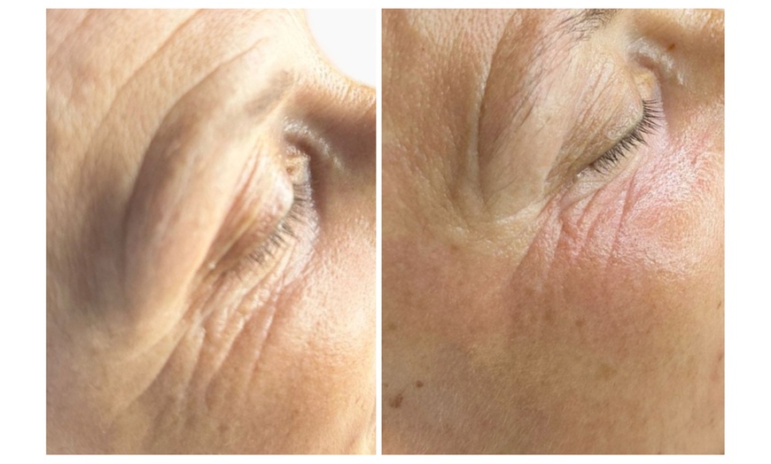 Image 2: Hydra Glow Hollywood Skin Care - Deluxe or Classic, or Mini Facial