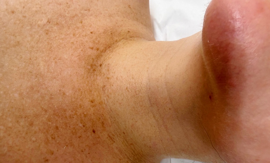 Image 2: Reveal Youthful Skin: One Chemical Peel at Floralis Aesthetics Clinic