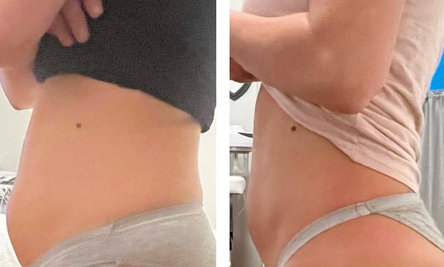 Image 4: Skin Tightening for Legs, Abs, Face Toning & Sculpting session/ More