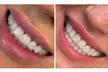 Achieve a Radiant Smile with In-Office Whitening/Cleaning Options at Millennium Dental (Up to 60% Off) - Second Medium