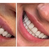 Image 5: Achieve a Radiant Smile with In-Office Whitening/Cleaning Options