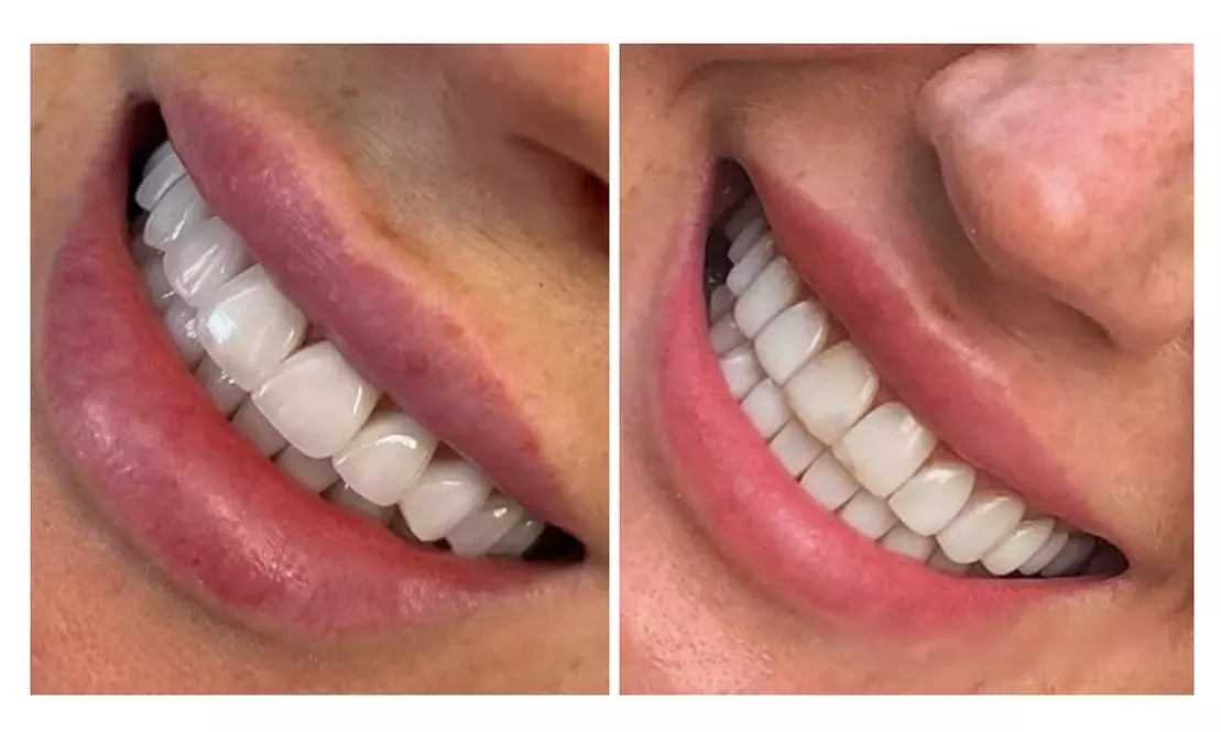 Achieve a Radiant Smile with In-Office Whitening/Cleaning Options